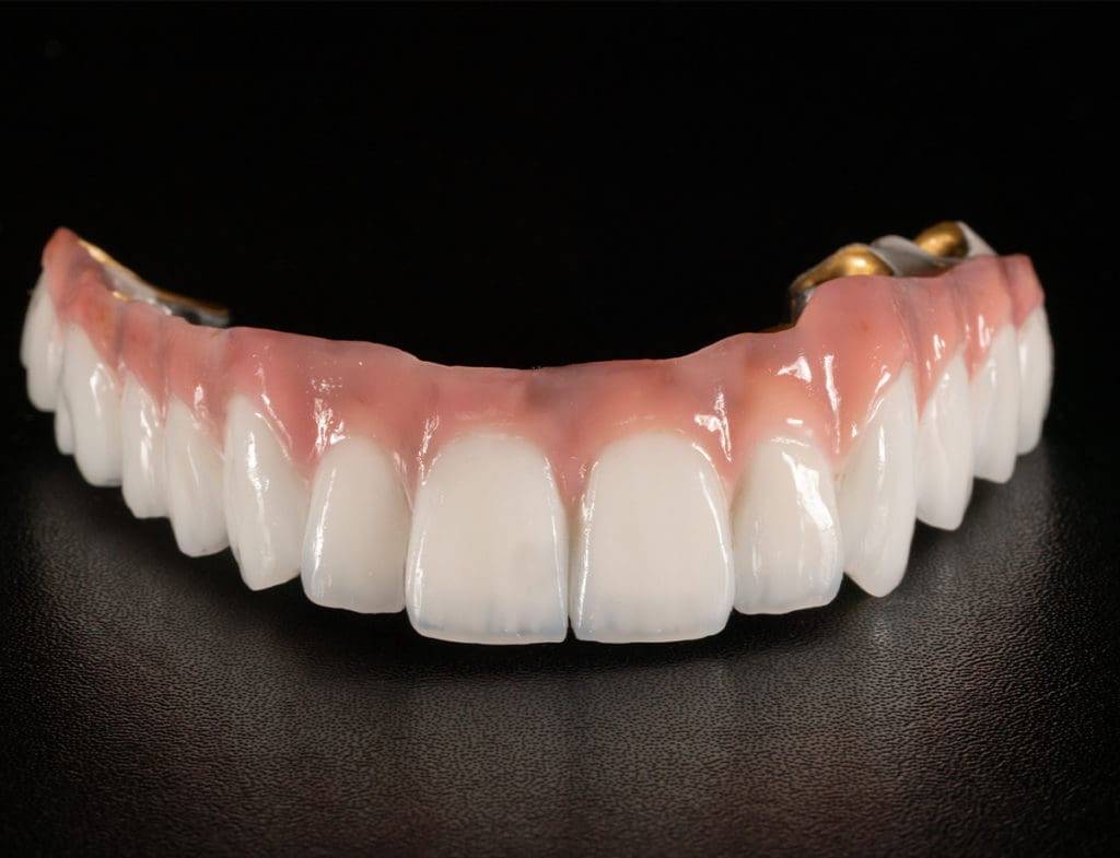 Provisorischer Zahnersatz 1